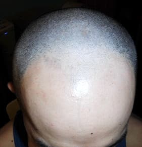 例11,生え際・頭頂部のヘアタトゥー、ビフォー写真