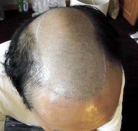 例6,頭部全体のヘアタトゥー、ビフォー写真