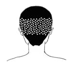 TYPE-Dのヘアタトゥー範囲図（植毛傷跡）