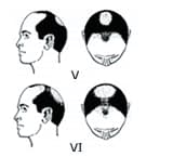 TYPE4のヘアタトゥー範囲図（男性）