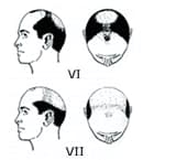 TYPE5のヘアタトゥー範囲図（男性）