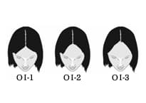 TYPE-01のヘアタトゥー範囲図（女性）