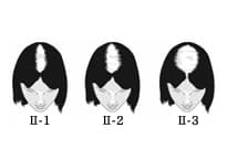 TYPE-2のヘアタトゥー範囲図（女性）