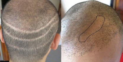 植毛による頭皮の傷跡の参考写真