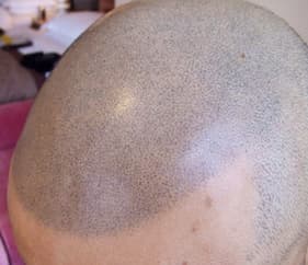 例5,生え際のヘアタトゥー、アフター写真