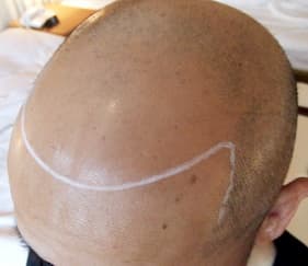 例5,生え際のヘアタトゥー、ビフォー写真