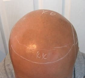 例7,頭部全体のヘアタトゥー、ビフォー写真