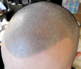 例11,生え際・頭頂部のヘアタトゥー、アフター写真