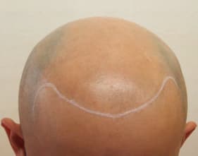 例8,頭部全体のヘアタトゥー、ビフォー写真