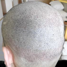 例10,植毛部分の傷跡のヘアタトゥー、アフター写真