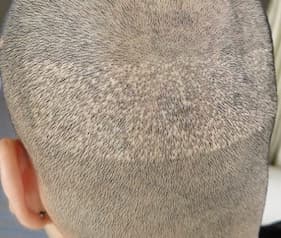 例10,植毛部分の傷跡のヘアタトゥー、ビフォー写真