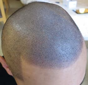 例6,頭部全体のヘアタトゥー、アフター写真