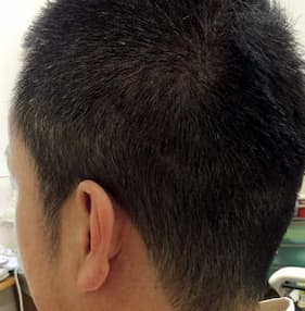 例9,植毛部分の傷跡のヘアタトゥー、アフター写真