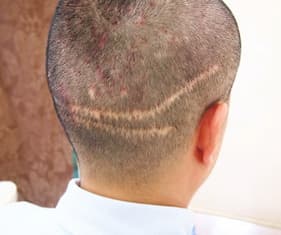 例9,植毛部分の傷跡のヘアタトゥー、ビフォー写真