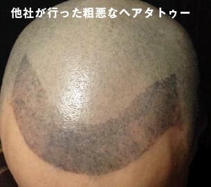 Spjヘアタトゥーのご予約 Aga治療ナビ