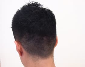 例2,植毛部分の傷跡のヘアタトゥー、アフター写真