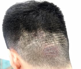 例2,植毛部分の傷跡のヘアタトゥー、ビフォー写真