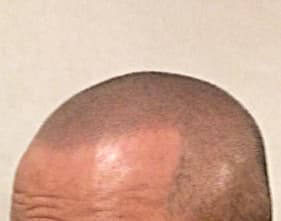 例3,頭部全体のヘアタトゥー、アフター写真