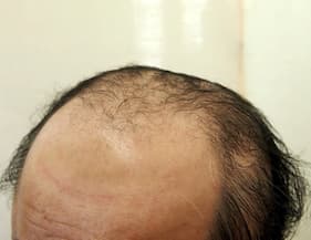 例3,頭部全体のヘアタトゥー、ビフォー写真