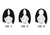 TYPE-02のヘアタトゥー範囲図（女性）
